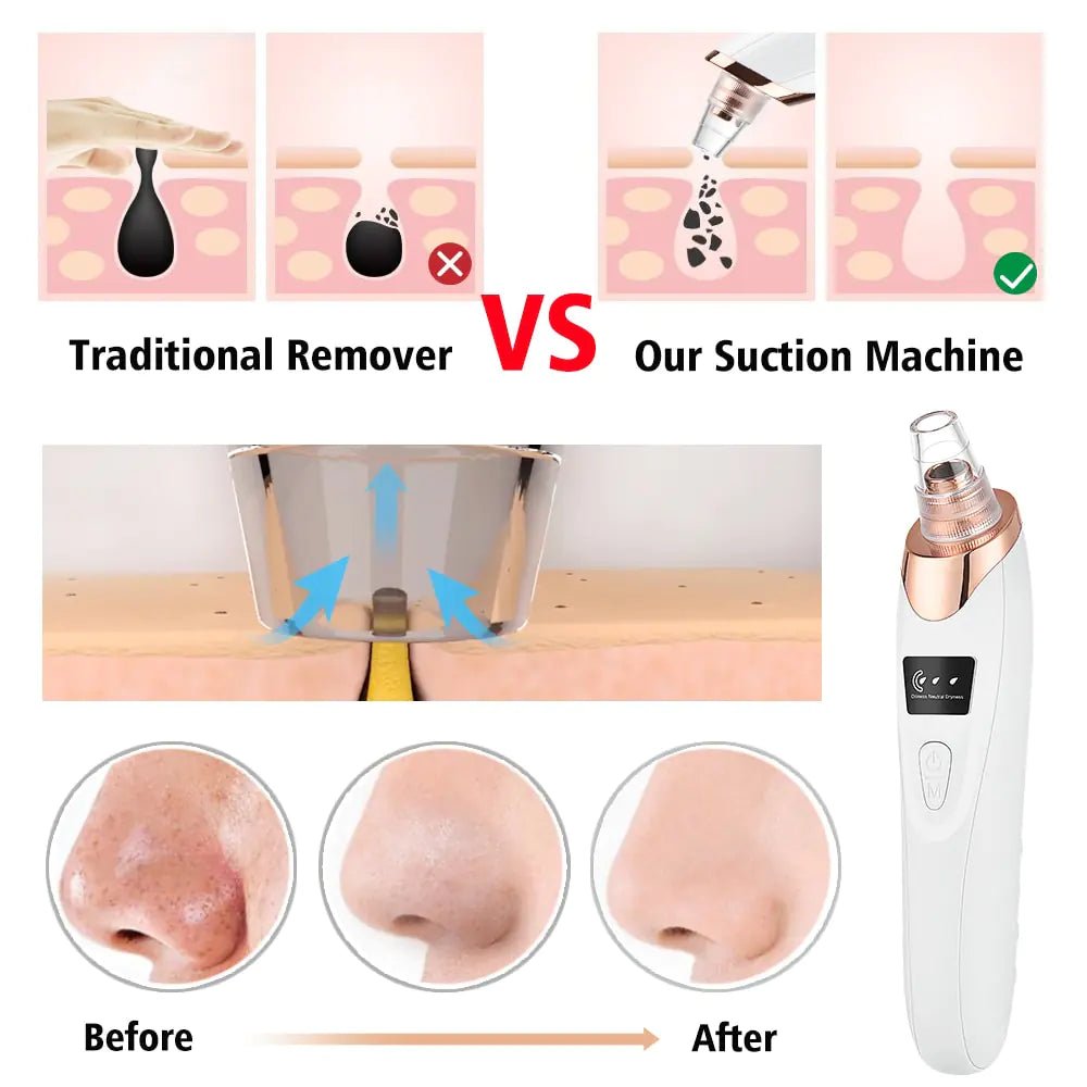 Beauty Electric Blackhead Remover - TTP